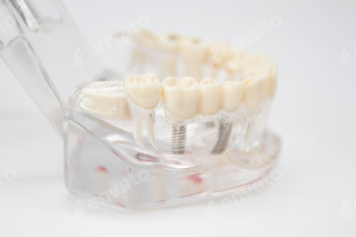 Preview: A demonstration jaw with an implant and an abutment