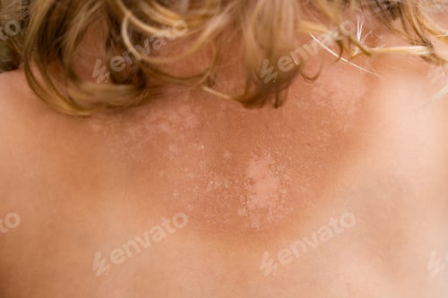 Preview: The skin is very peeling after sunbathing, the tanned back of a little girl. Sunburn concept
