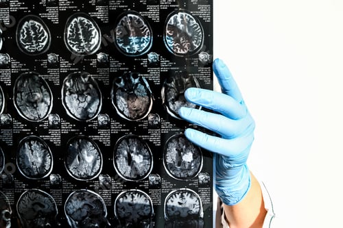 Preview: Doctor in protecting gloves holding brain MRI in medical office. MRI scan of human head in clinic.