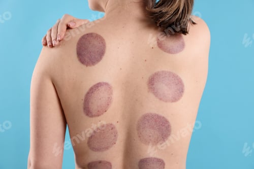 Preview: Woman after cupping therapy on light blue background, closeup