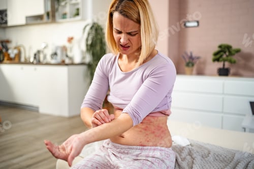 Preview: Woman scratching itchy skin with red rash at home