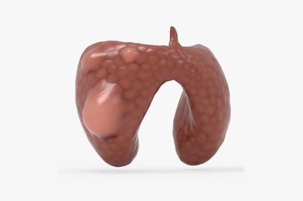 Preview: Thyroid Gland with Papillary Cancer