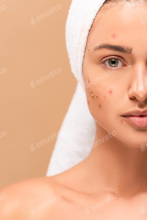 Preview: cropped view of naked girl in towel with acne on face isolated on beige