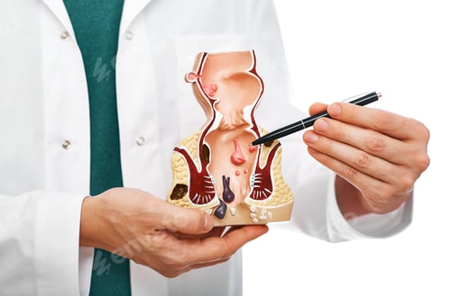 Preview: Treatment of rectal diseases, hemorrhoid. Proctologist pointing pen rectum pathologies on an
