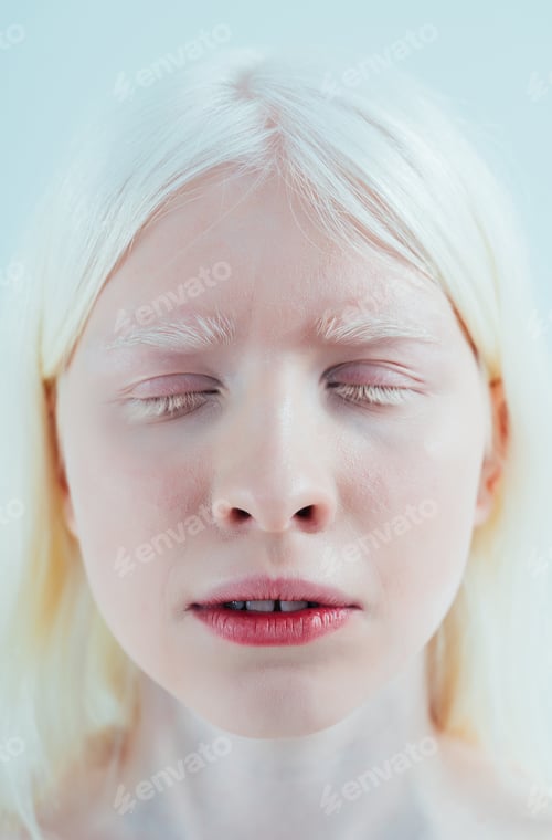 Preview: Beauty image of an albino