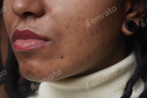 Preview: Acne Scars Close Up