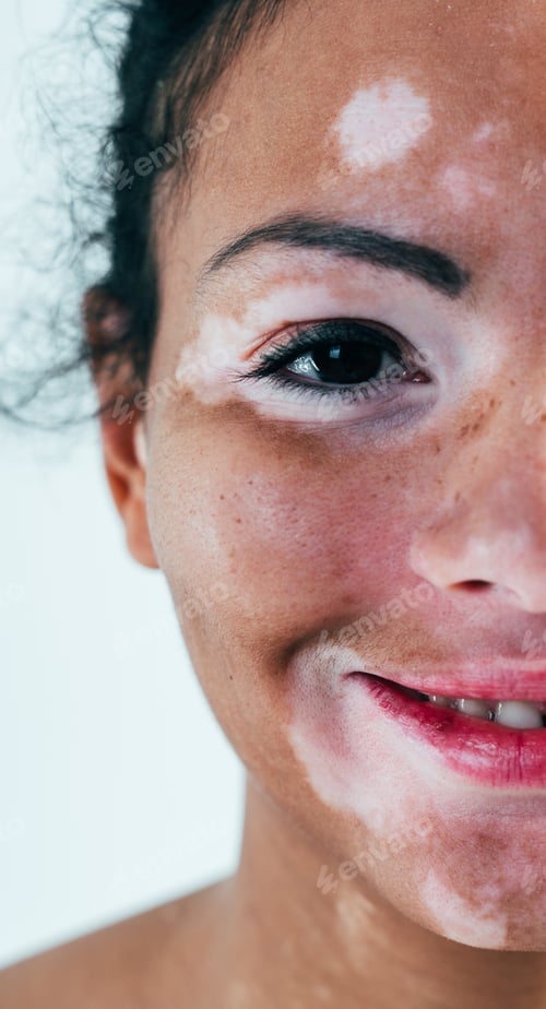 Preview: Beautiful woman with vitiligo skin
