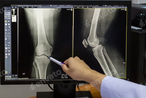 Preview: Doctor pointing on the knee problem point on x-ray film.
