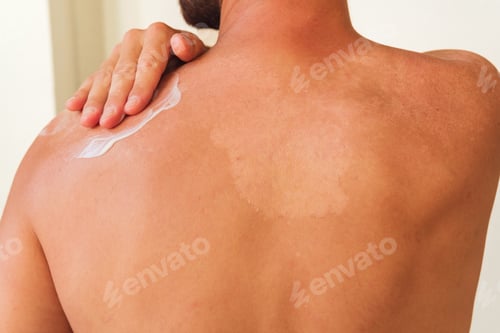 Preview: Unrecognizable man applying after sun cream on his back with sunburn. sun protection concept.