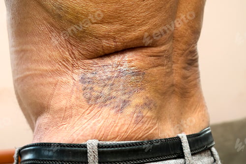 Preview: bruise on the man's back,coccyx after falling down. back aching. Back psoriasis.health and medicine