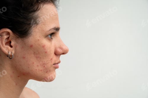 Preview: Close-up skin texture with red pimples, irritation and clogged pores