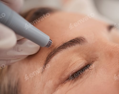 Preview: Closeup shot of a mature woman enjoying a micro-needling treatment at a spa