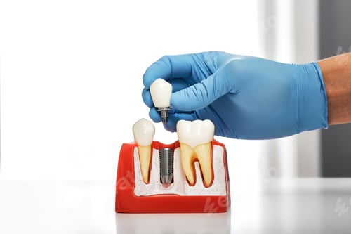 Preview: Dentist showing the installation of a dental implant on the anatomical model of teeth, close-up.
