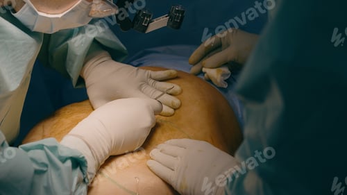 Preview: Two men doctors surgeon physician hands cut scalpel make incision on patient abdomen stomach belly