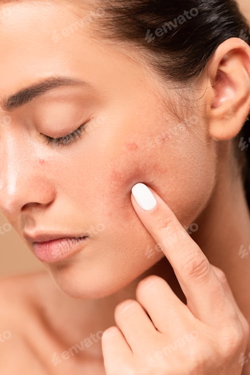 Preview: young woman pointing with finger at face with problem skin isolated on beige