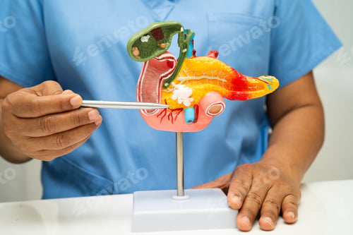 Preview: Pancreatitis, pancreatic cancer, Asian doctor with pancreas, gallbladder