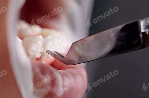 Preview: Dental forceps holding ceramic bracket attaching it to clean white tooth of lower jaw