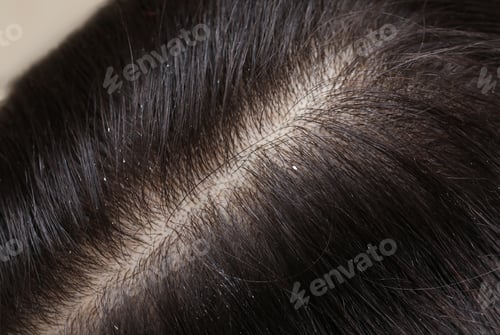 Preview: Woman with dandruff in her dark hair, closeup view