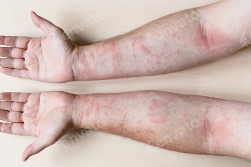 Preview: male arms with inflamed skin