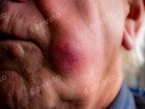 Preview: painful under skin abscess on side of face