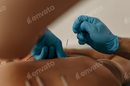 Preview: Doctor applying acupuncture needles to patient's back for pain relief