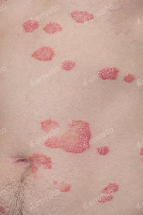 Preview: Psoriasis Vulgaris, skin patches are typically red, itchy, and scaly.