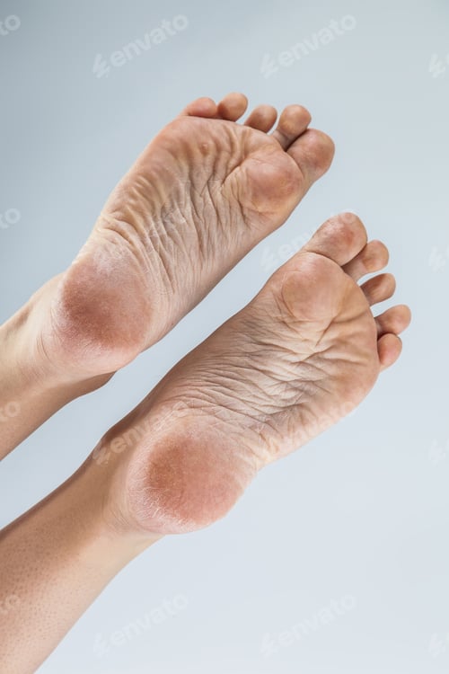Preview: dehydrated skin female heels