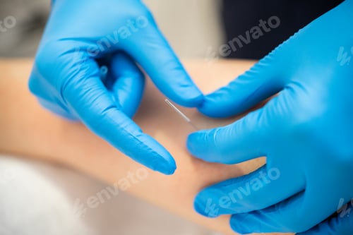 Preview: Hands of physiotherapist doing a dry needling