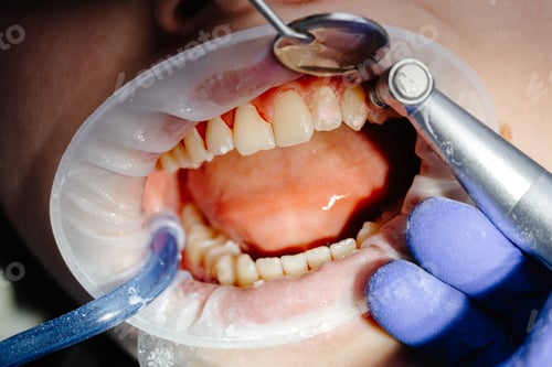 Preview: Dentist performing dental checkup cleaning teeth of patient wearing protective glasses