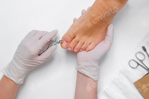 Preview: Pedicure, podologist. Patient on medical pedicure procedure, nail disease, cholesis detachment of th