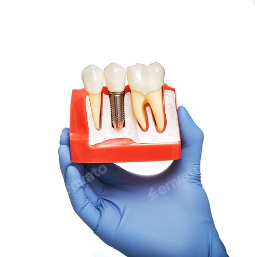 Preview: Dentist holding an anatomical model of teeth with a dental implant in his hand, close-up. Dental