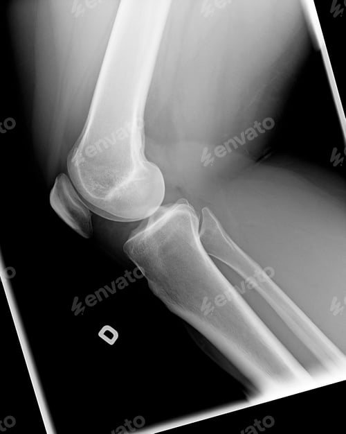 Preview: X-ray of knee with Chondromalacia condition