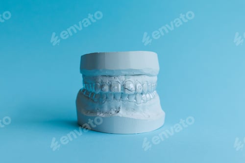 Preview: Dental plaster model of human jaw before treatment with braces
