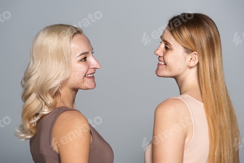 Preview: Side view of smiling friends with skin issue looking at each other isolated on grey