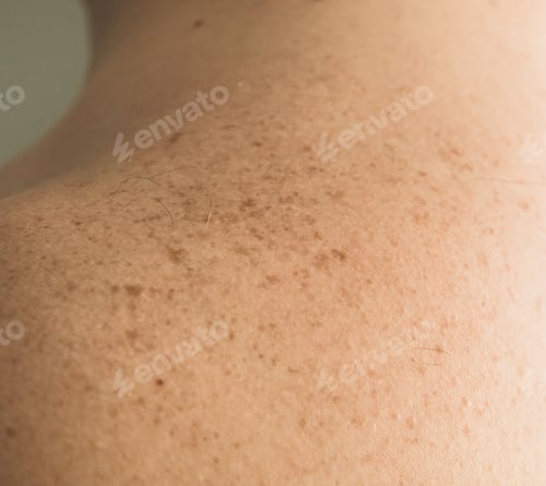 Preview: Skin on a man back with scattered moles
