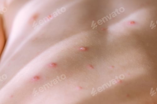 Visualização: Chickenpox blisters on body of child