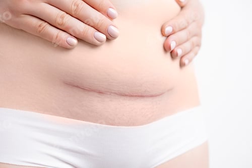 Vista previa: Woman belly with a scar from a cesarean section on the white background