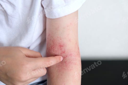 Preview: The child scratches atopic skin.