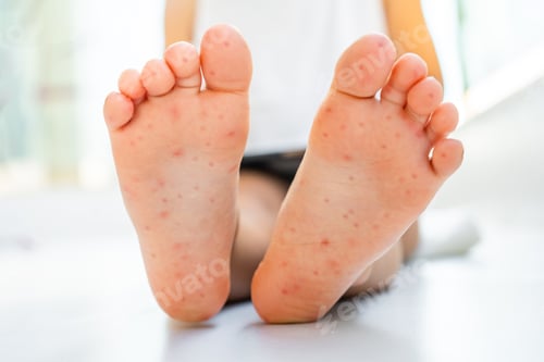 Preview: Enterovirus Leg - arm - mouth. Rash on the body of a child. Cocksackie virus. High quality photo
