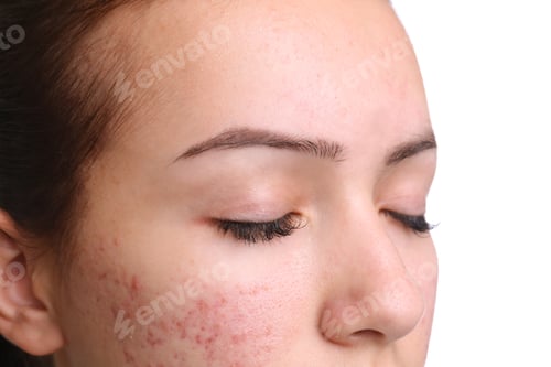 Preview: Teenage girl with acne problem on white background, closeup