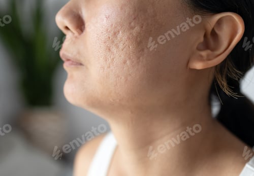 Preview: Teenage girl with acne problem, closeup