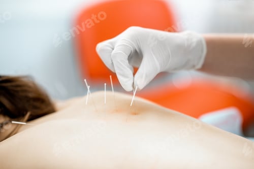 Preview: Acupuncture medical treatment
