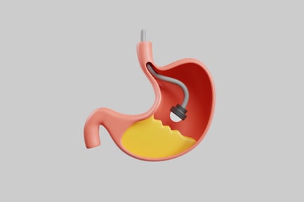 Preview: Stomach endoscopy procedure visualization
