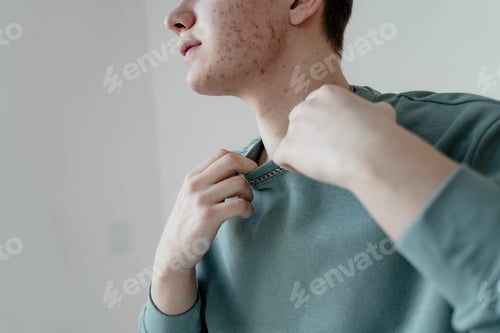 Preview: a guy in a turquoise sweater with problem skin on his face, acne, a teenager in transitional age