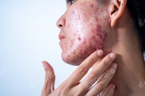 Preview: Acne on face because the disorders of sebaceous glands productions. Acne or a Cosmetic Allergy.