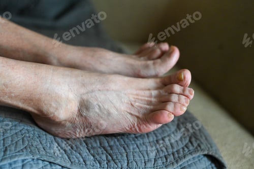 Preview: senior woman foot with medical condition, arthritis and fungus