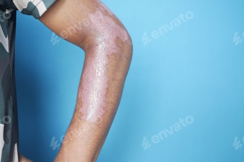 Preview: burns on man hand on blue background .