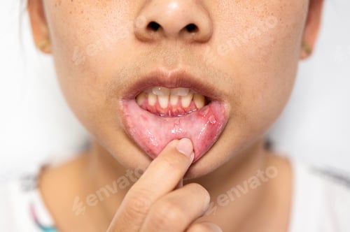 Preview: Asian woman have Aphthous ulcer or Canker sore on mouth at lip
