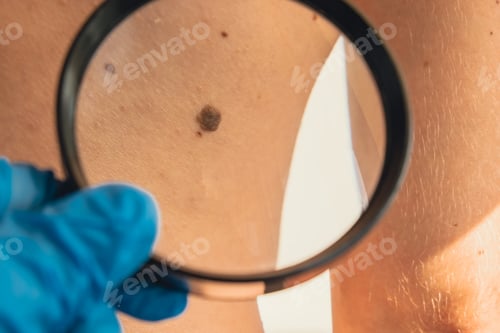 Preview: Mole dermoscopy, preventive of melanoma. Dermatologist examining patient's birthmark with magnifying