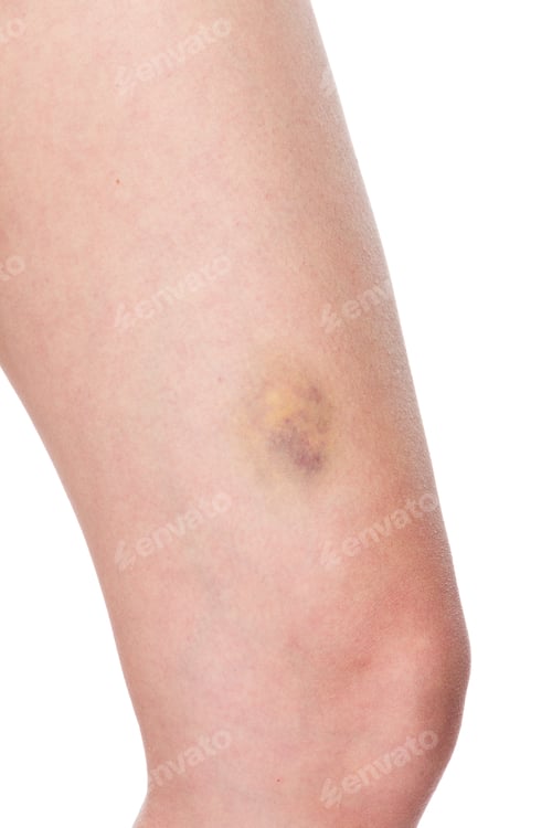 Preview: Woman with sore leg